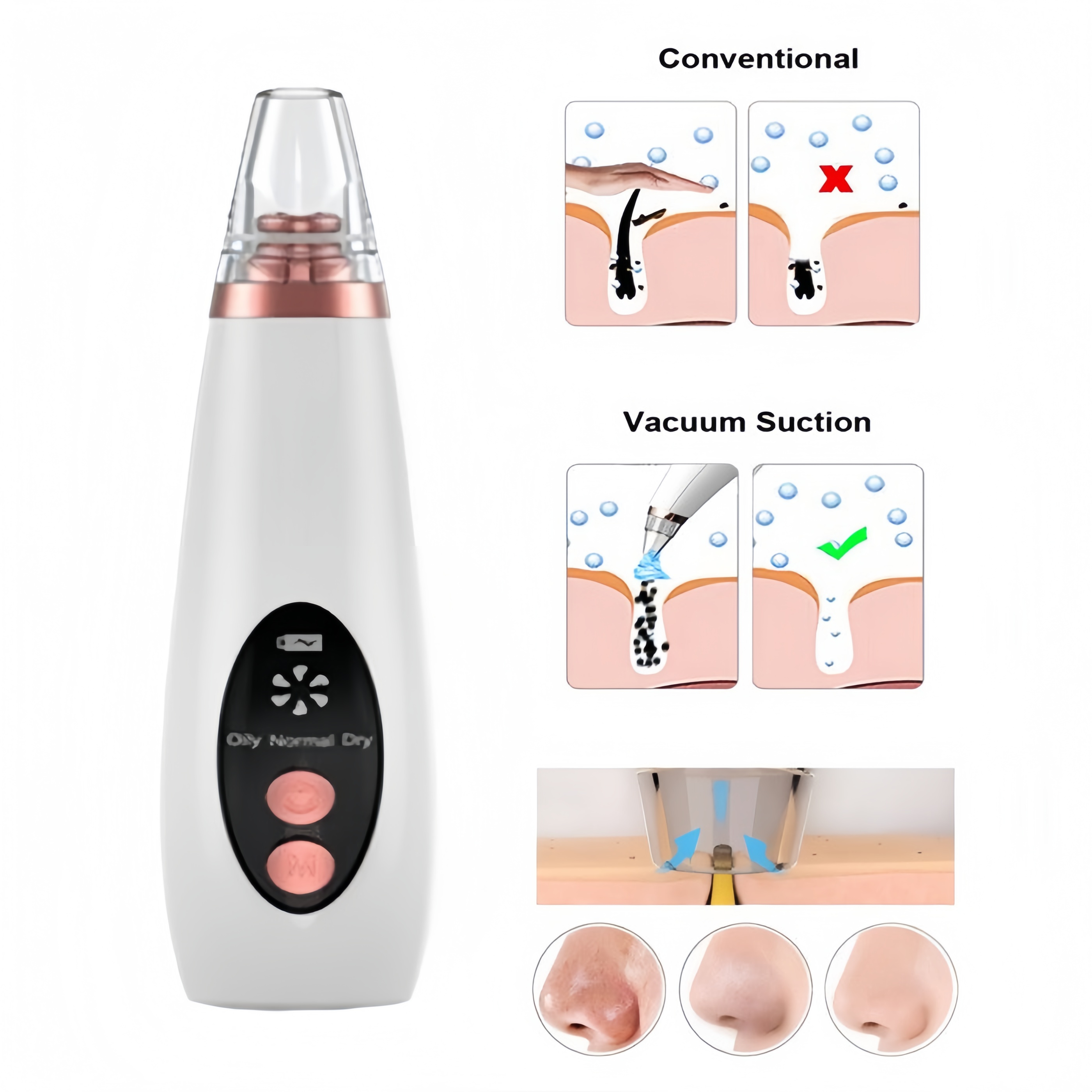 6 In 1 Derma Suction blackhead remover machine